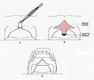 uvulopalatal flap